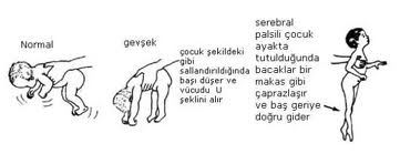 serebral paralizi2-18d.jpg